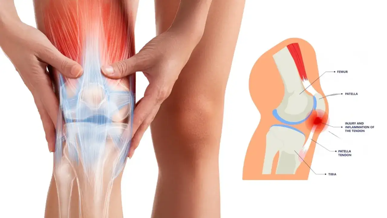 Dolore al ginocchio dovuto a sovraccarico muscolare e infiammazione del tendine rotuleo.